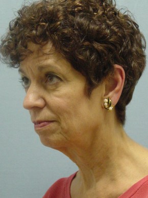 Dermal Fillers