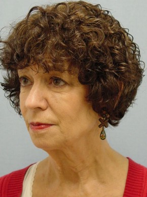 Dermal Fillers