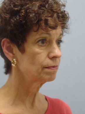 Dermal Fillers