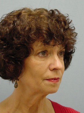 Dermal Fillers