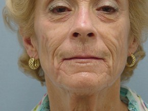 Dermal Fillers