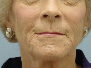 Dermal Fillers