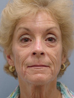 Dermal Fillers