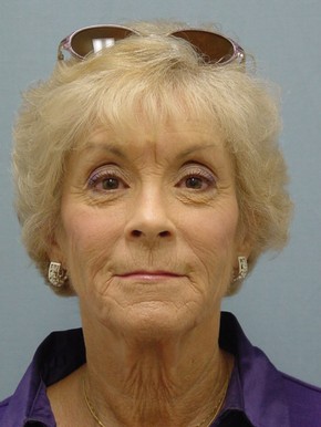 Dermal Fillers