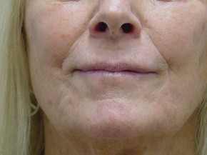Dermal Fillers