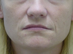Dermal Fillers