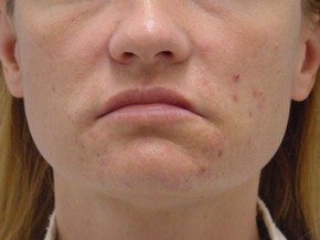 Dermal Fillers