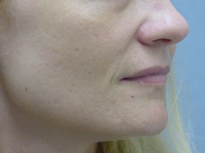 Dermal Fillers