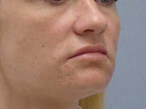 Dermal Fillers