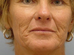 Dermal Fillers