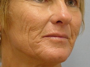 Dermal Fillers