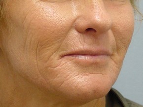 Dermal Fillers