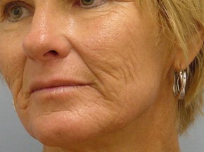 Dermal Fillers