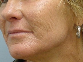 Dermal Fillers