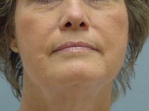 Photofacial Rejuvenation