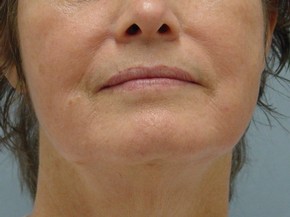 Photofacial Rejuvenation