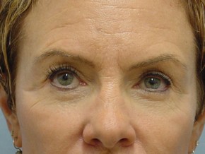 Tear Troughs