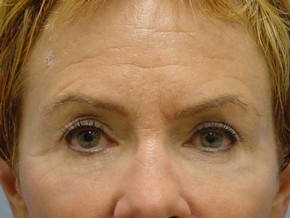 Tear Troughs