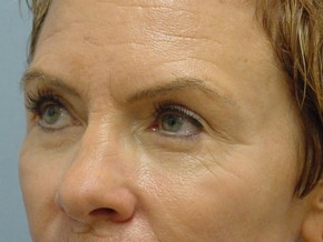 Tear Troughs
