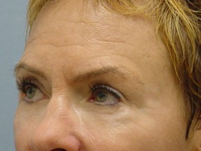 Tear Troughs