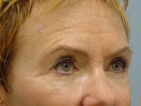 Tear Troughs