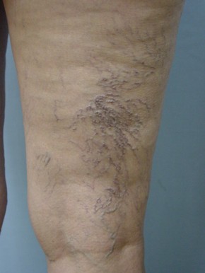 Veins