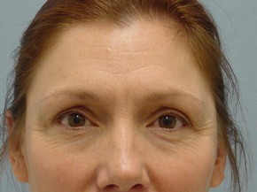Browlift