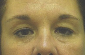 Browlift