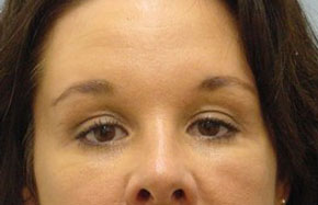 Browlift