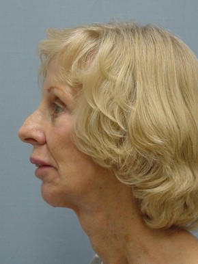Browlift