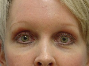 Browlift