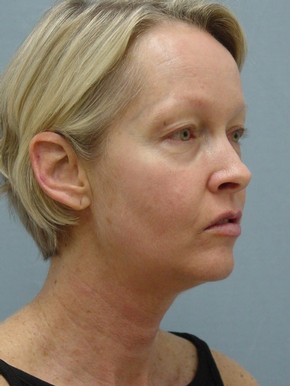 Browlift