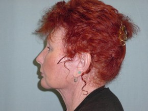 Browlift
