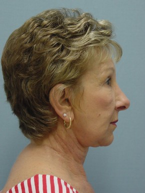 Browlift