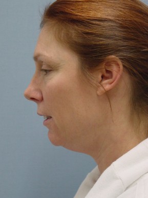 Chin Augmentation