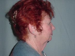Chin Augmentation