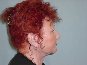 Chin Augmentation