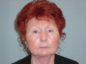 Chin Augmentation