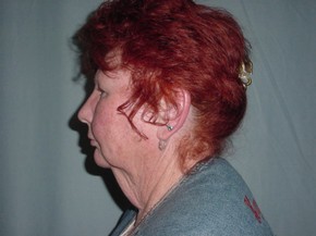 Chin Augmentation
