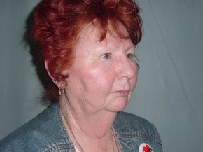 Chin Augmentation