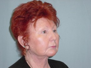 Chin Augmentation