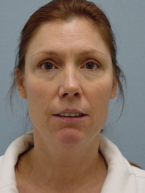 Face Fat Grafting