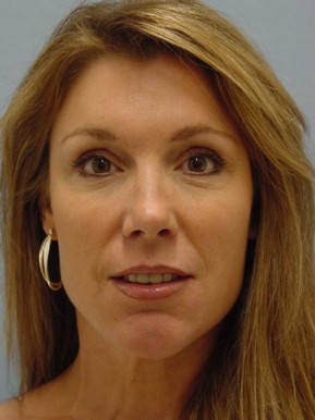 Face Fat Grafting