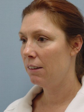 Face Fat Grafting