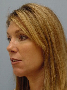 Face Fat Grafting