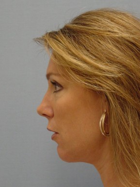 Face Fat Grafting