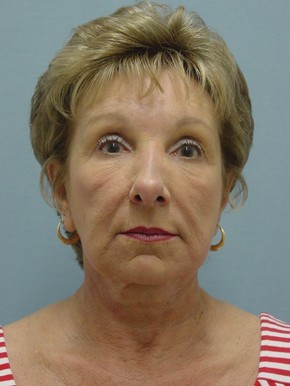 Face Fat Grafting