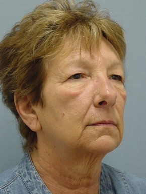 Face Fat Grafting