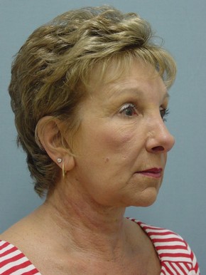 Face Fat Grafting