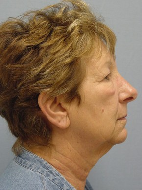 Face Fat Grafting